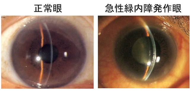 緑内障 ブログ