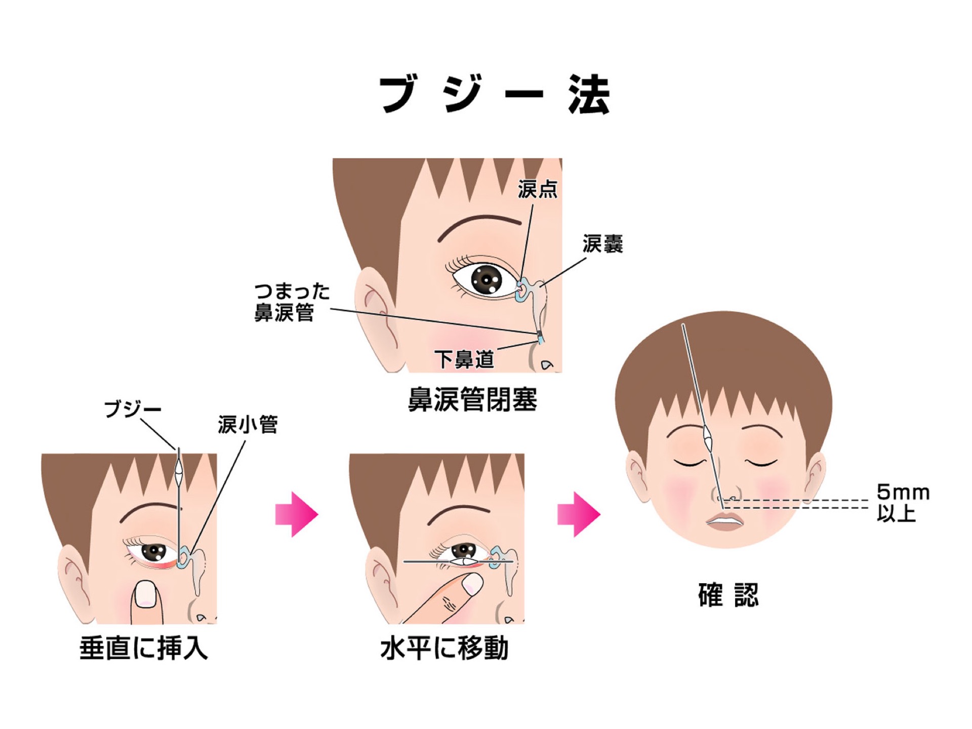 鼻涙管ブジー（先天鼻涙管閉塞） サトウ眼科（つくば市） 院長ブログ