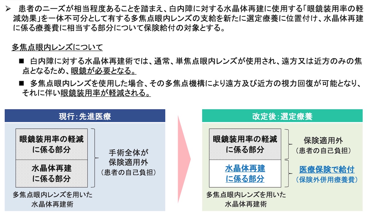 手術 費用 白内障