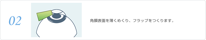 角膜表面を薄くめくり、フラップをつくります。