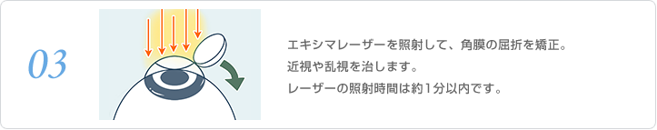 エキシマレーザーを照射して、角膜の屈折を矯正。近視や乱視を治します。レーザーの照射時間は約30秒以内です。