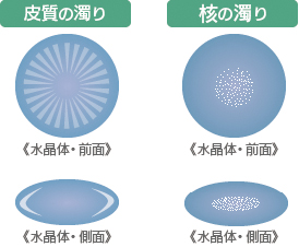 水晶体の濁り方と症状